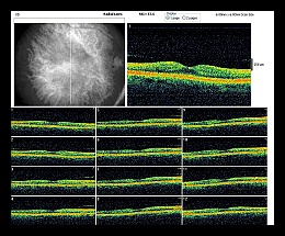 RADIAL LINES OD